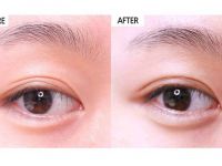北京艾玛李方奇双眼皮修复案例  北京艾玛李方奇双眼皮修复技术怎么样？