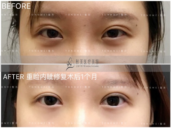 眼修复是找刘风卓还是王世勇？哪个修复双眼皮技术靠谱？