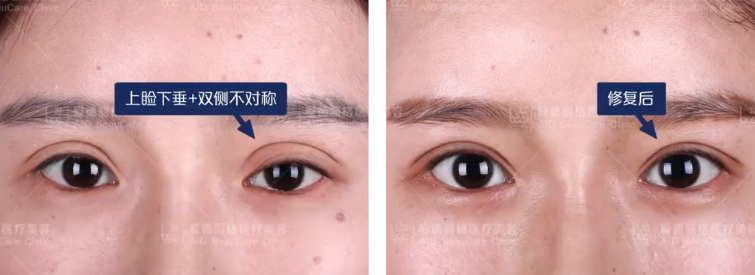 中国双眼皮修复专家排名