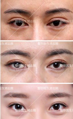 刘志刚宽变窄双眼皮修复案例