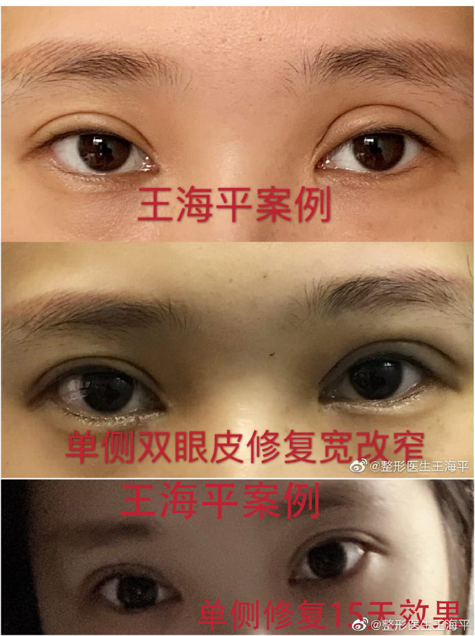 王海平双眼皮修复案例