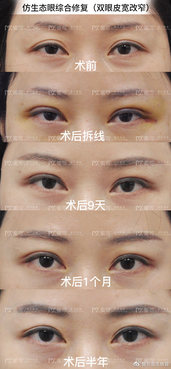 杨蓉双眼皮修复案例
