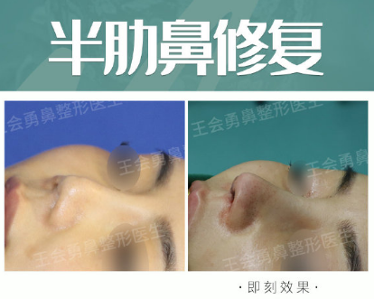 2020年上海鼻修复专家排名 2020年上海鼻修复医生排行榜