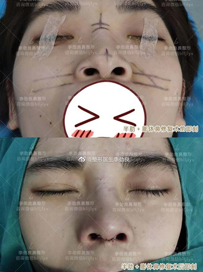 中国哪个医生取鼻子假体最厉害？鼻部假体取出专家排名