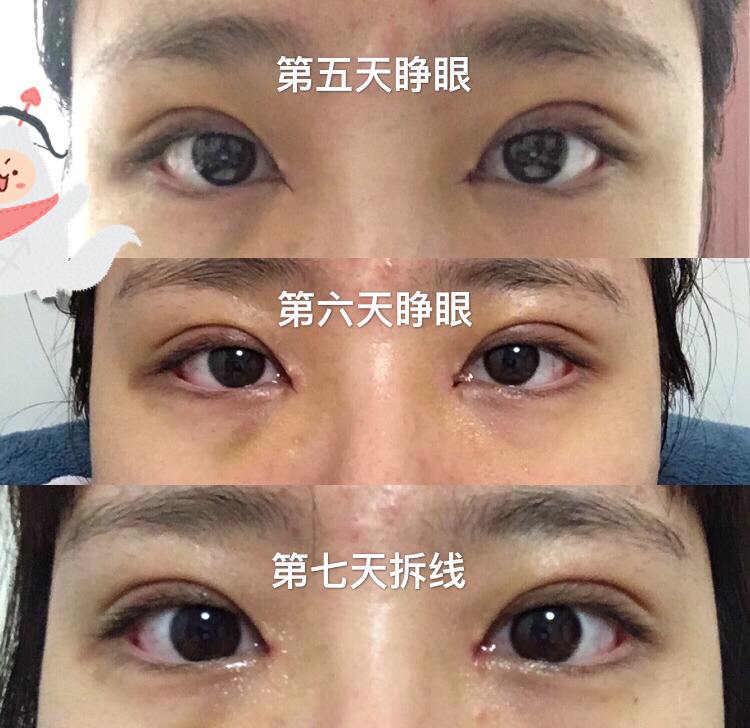 上海九院双眼皮修复最好的专家有哪些？