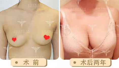 北京自体脂肪隆胸最好的医生前十名预约排行榜