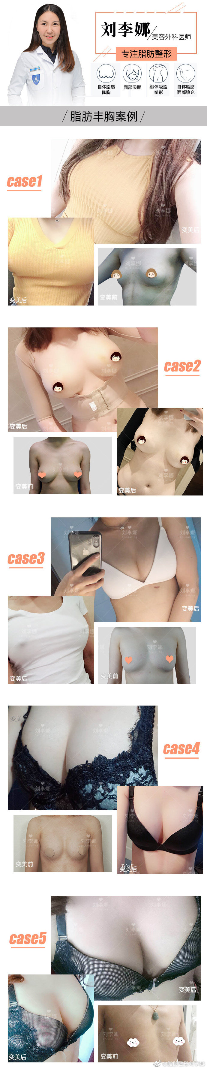 刘李娜自体脂肪隆胸案例