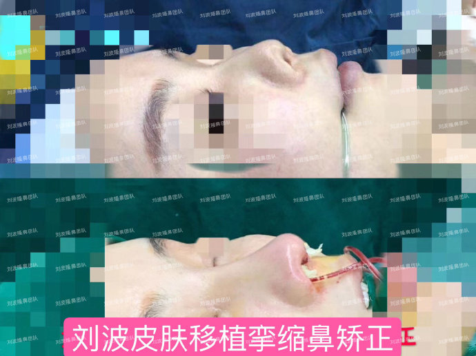 刘波鼻修复案例