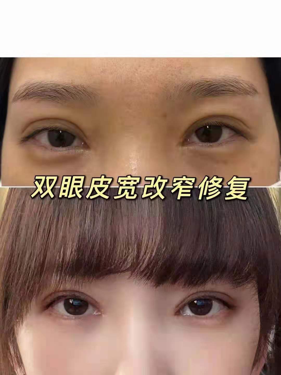 彭昌福修复双眼皮案例
