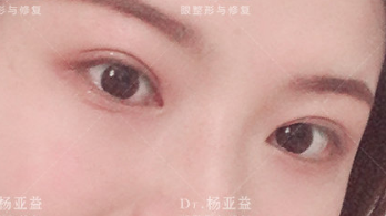 杜园园和杨亚益修复双眼皮谁更厉害