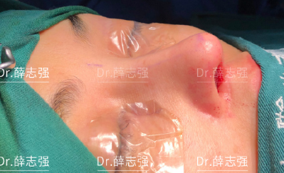 北京薛志强做鼻子怎么样