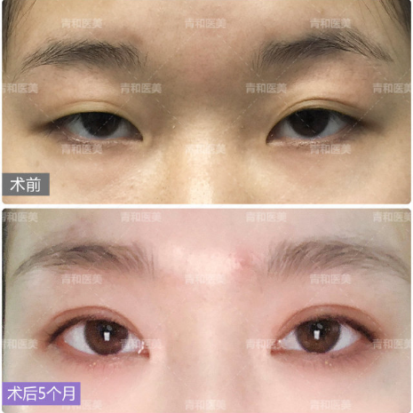 彭青和割双眼皮怎么样