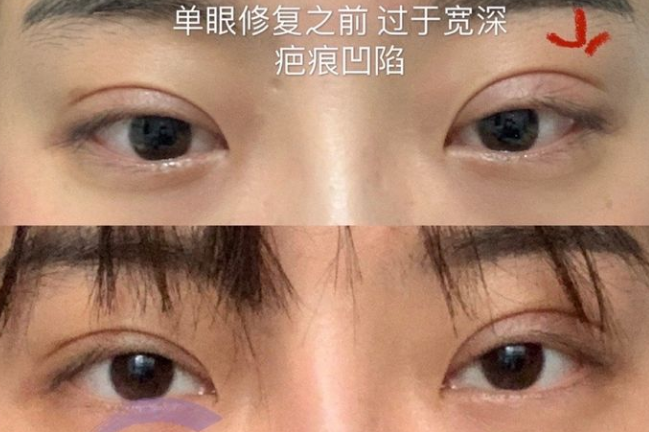 南京蔡薇双眼皮做得怎么样