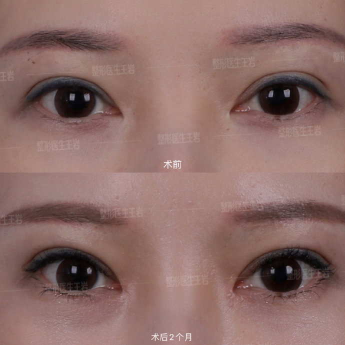 王岩做双眼皮修复案例