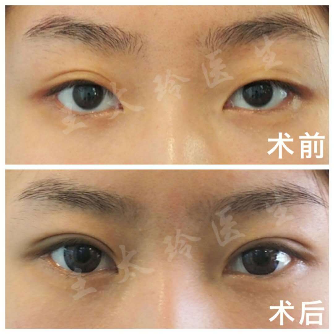 王太玲修复双眼皮案例