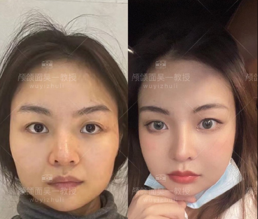 吴一医生做改脸型技术怎么样
