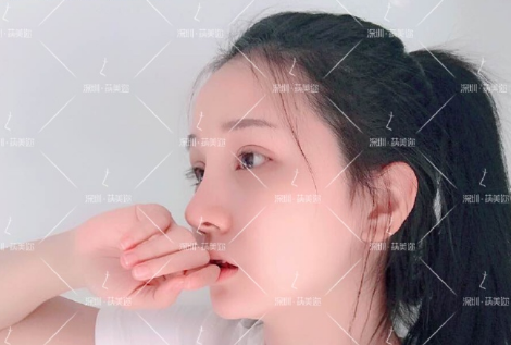 深圳朱灿做鼻子怎么样