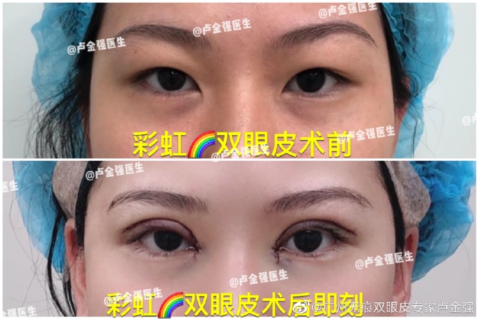 暨南卢金强割双眼皮怎么样