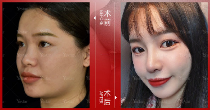 深圳牛克辉做鼻子怎么样