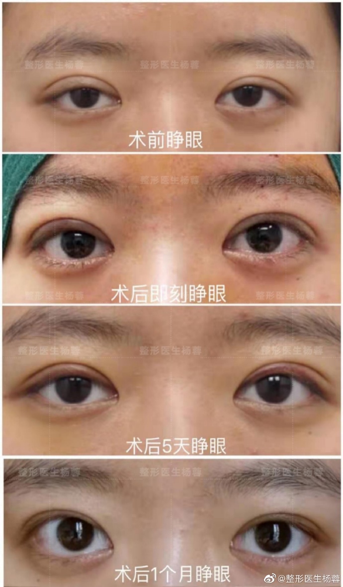 杨蓉修复双眼皮案例