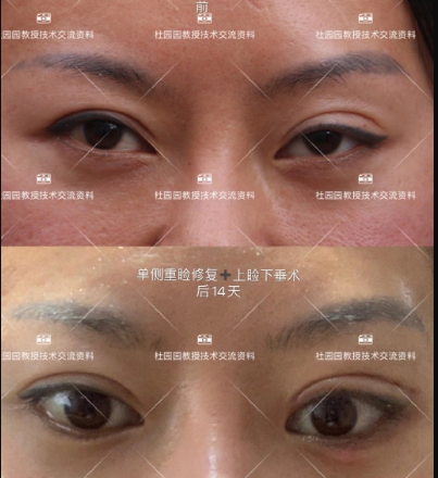 中国修复双眼皮最好的医生是谁