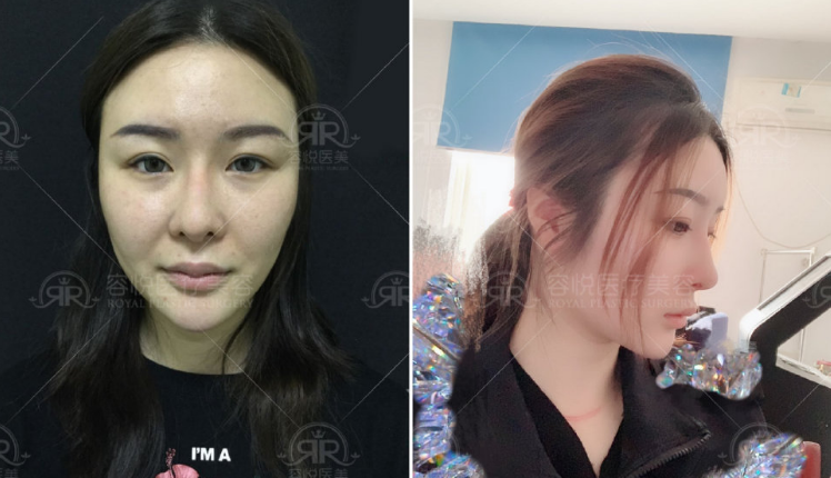 蒋亚楠做鼻子怎么样