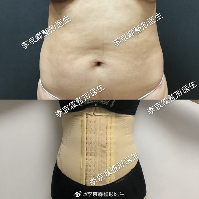 李京霖吸脂怎么样，技术好吗