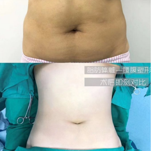 季一发吸脂技术怎么样