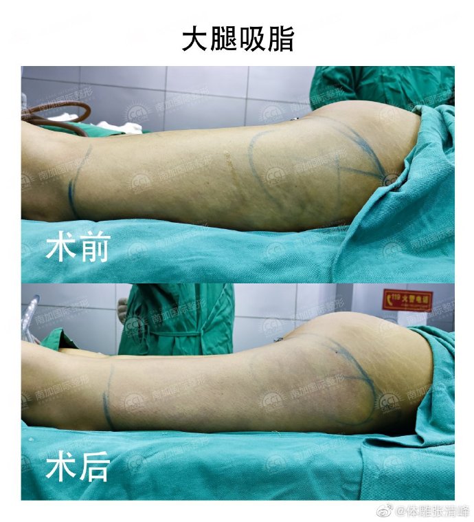 张清峰医生大腿吸脂怎么样