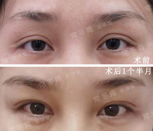 北京常冬青双眼皮修复技术简介案例预约
