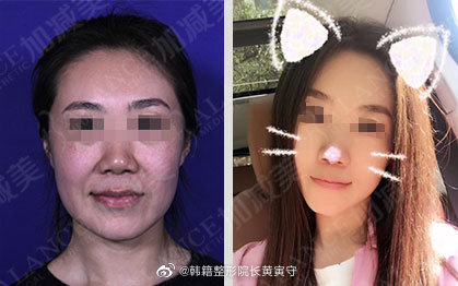北京加减美黄寅守医生做面部拉皮提升技术好吗？