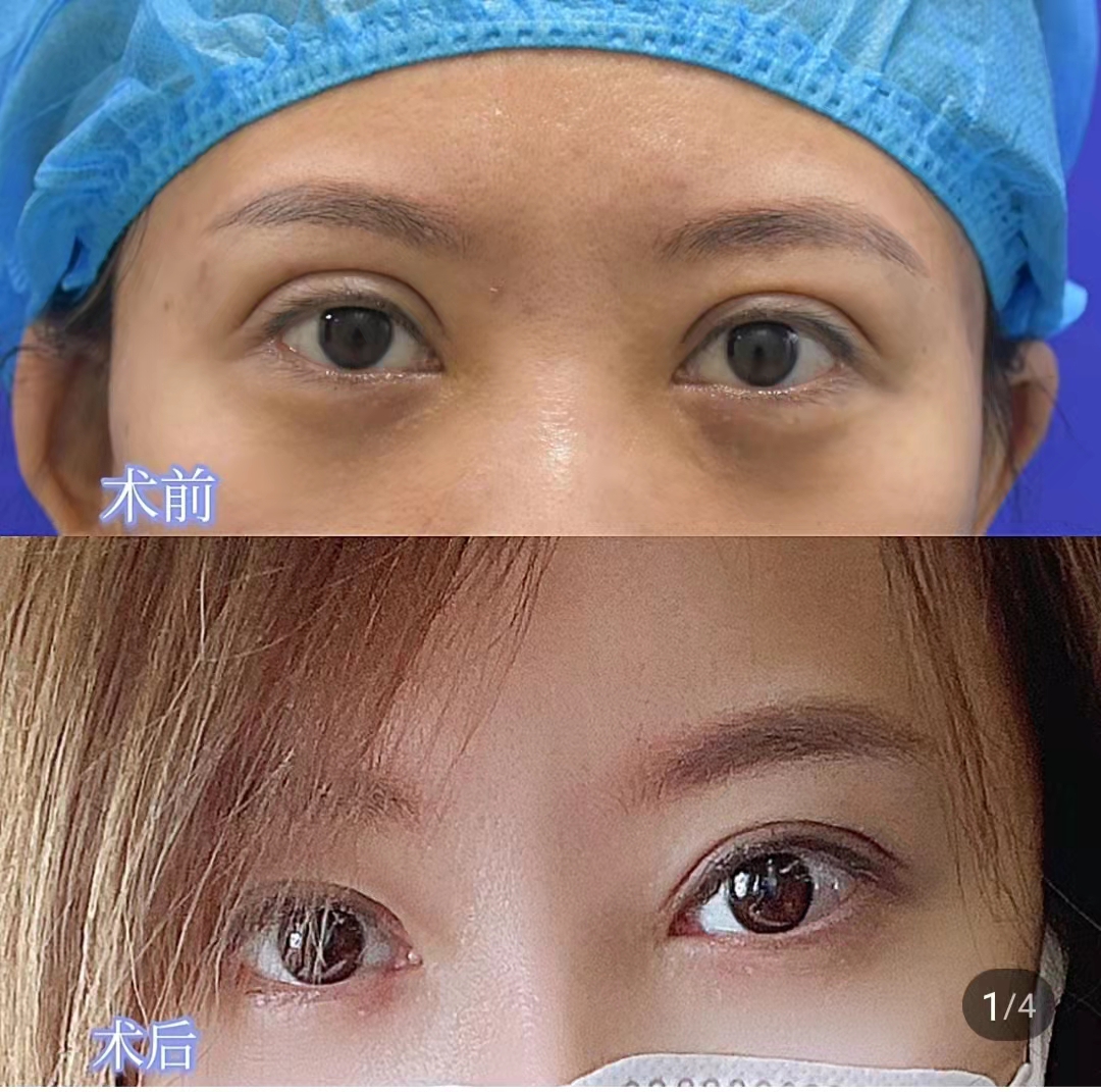 2022年国内双眼皮修复最厉害的是谁？