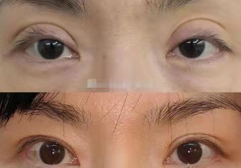 2022年南京做双眼皮修复最好的医生排名