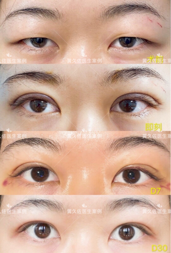 北京协和医院黄久佐做双眼皮技术口碑怎样？