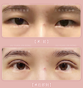 上海九院金蓉做双眼皮&眼修复技术怎么样？