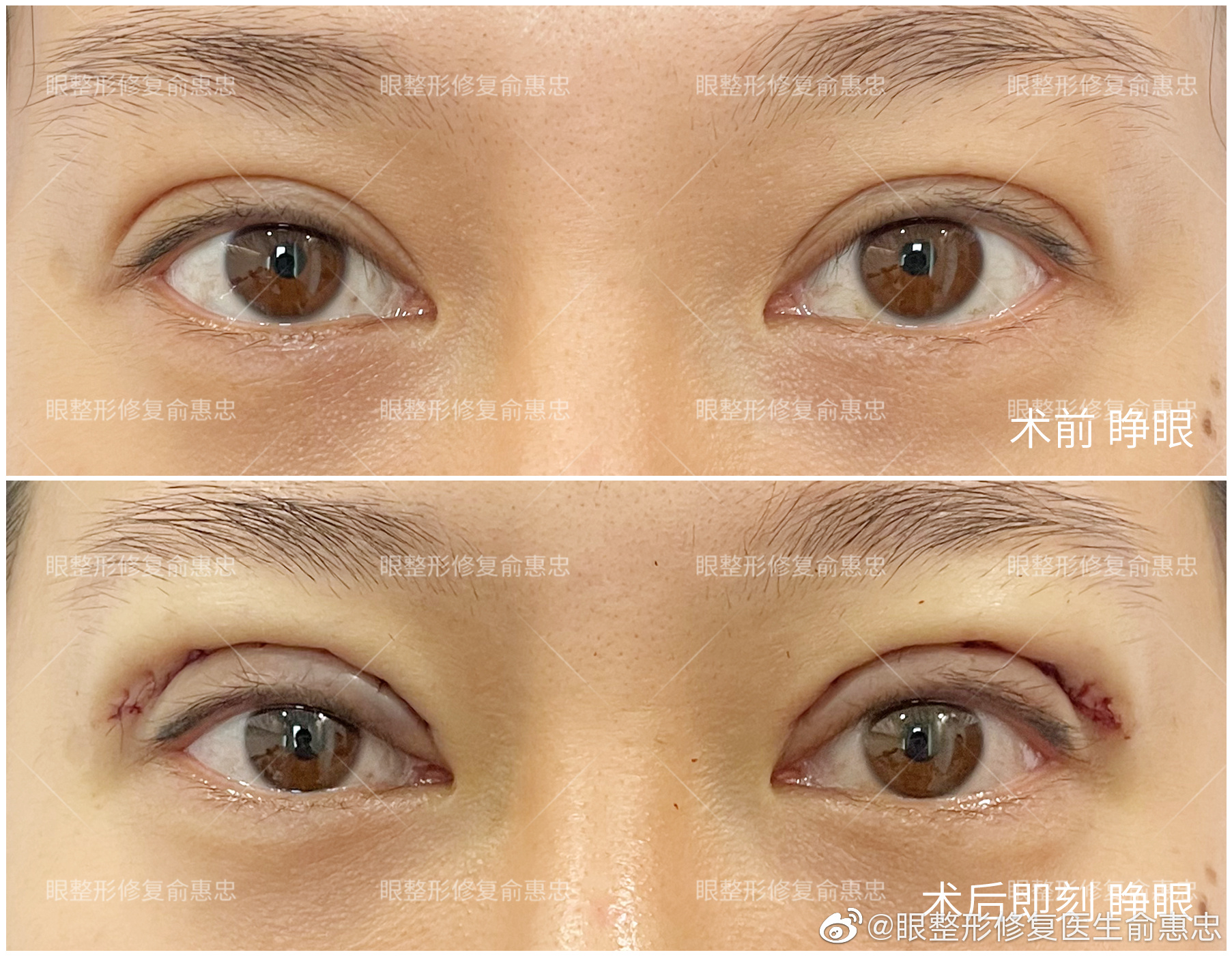 俞惠忠双眼皮修复案例