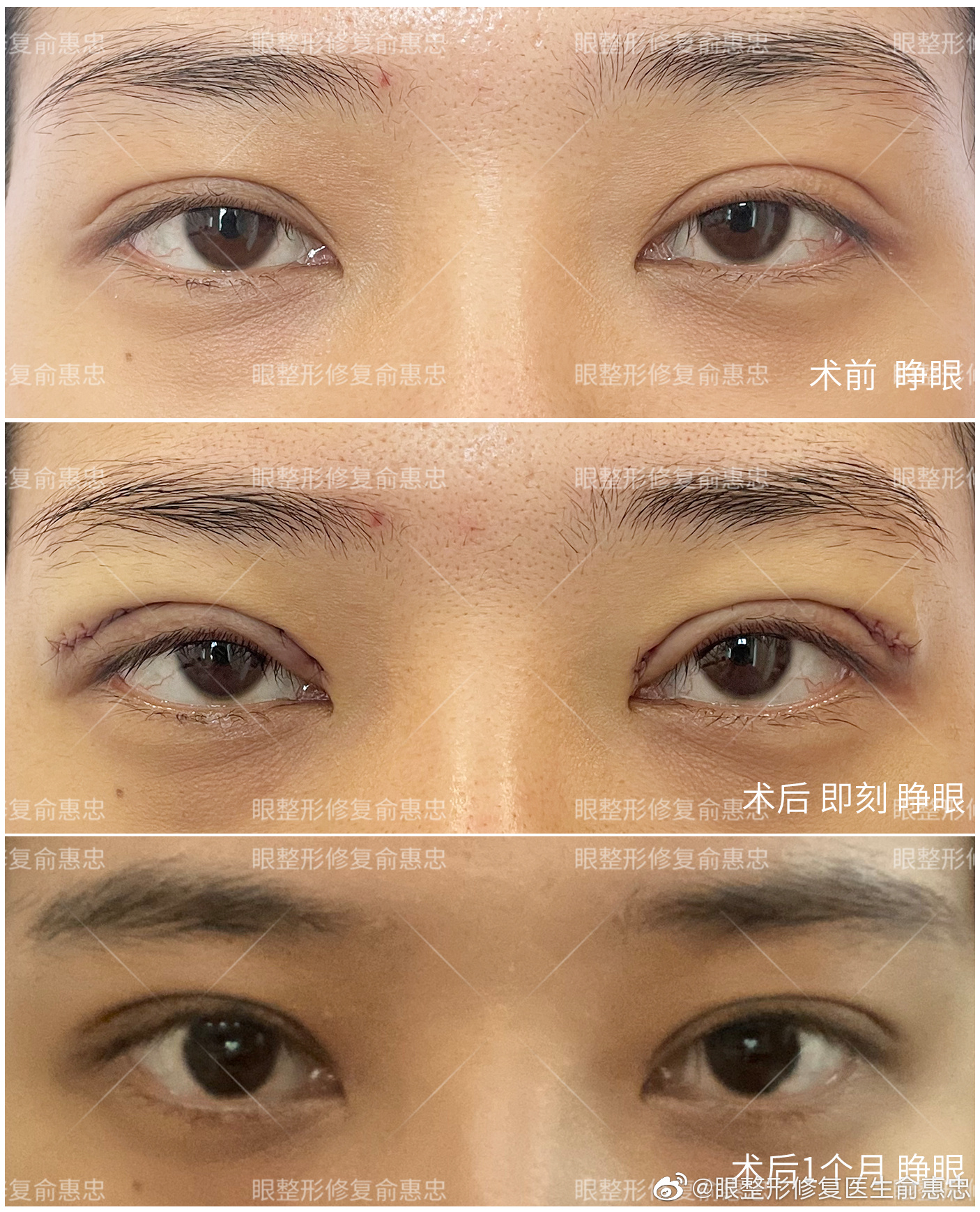 俞惠忠双眼皮修复案例