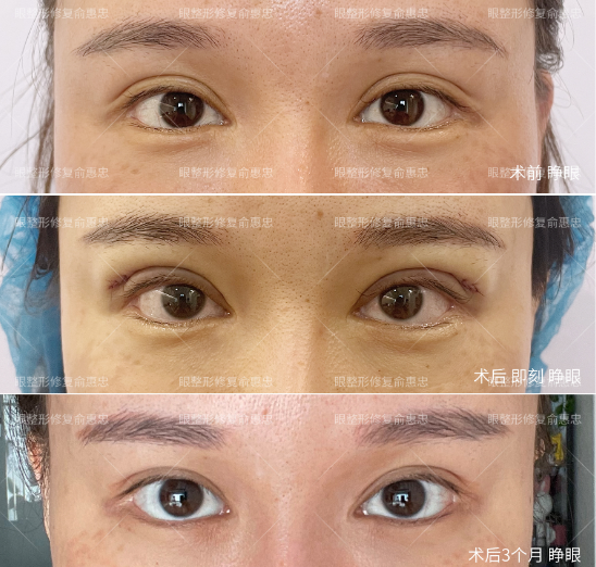 长沙双眼皮医生俞惠忠做眼睛技术怎样？