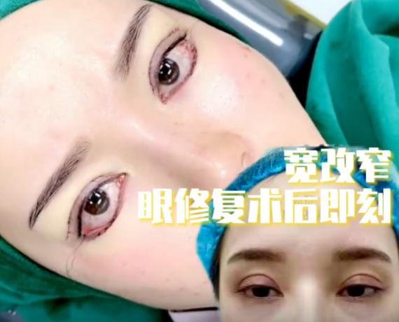 上海整形医生魏少魁做修复双眼皮怎么样？