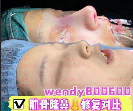 上海隆鼻专家李章医生鼻修复技术怎么样？