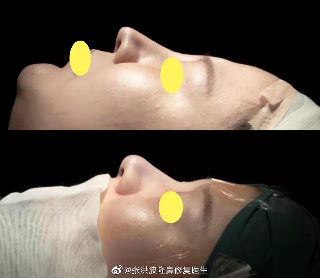 上海隆鼻医生张洪波做隆鼻技术怎么样？