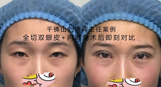 刘瑞鸣割的双眼皮技术怎么样？