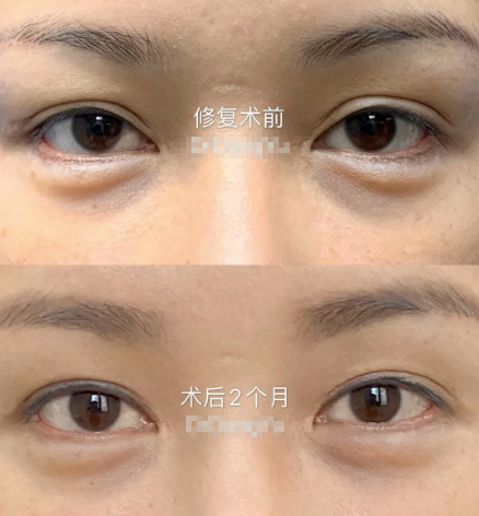 北京双眼皮专家范巨峰双眼皮修复技术怎么样？