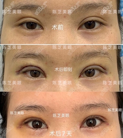 陳芝修復雙眼皮案例