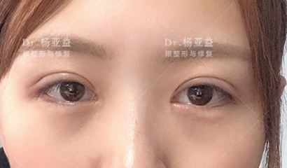 杨亚益和陈芝哪个双眼皮修复技术更好？