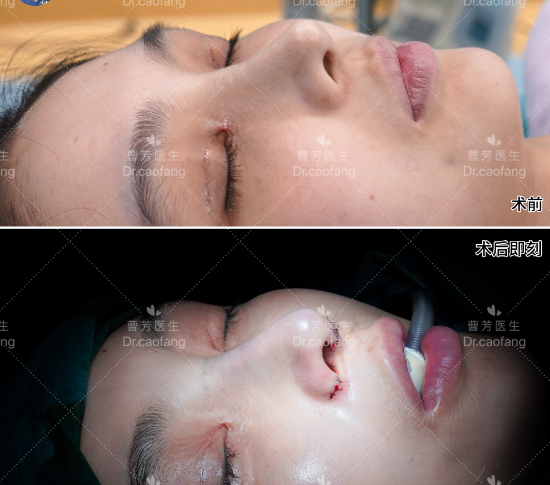 上海伯思立曹芳做鼻子技术怎么样？