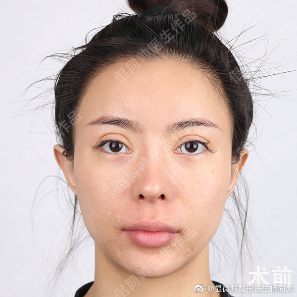 上海华美佀同帅双眼皮修复技术怎么样？