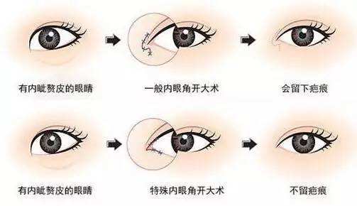 杭州双眼皮修复知名专家排行榜  杭州最好的双眼皮修复专家排名 杭州最好的双眼皮修复专家有哪些？