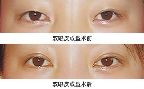 郑州双眼皮修复权威专家排行榜 郑州双眼皮修复最好的专家排名