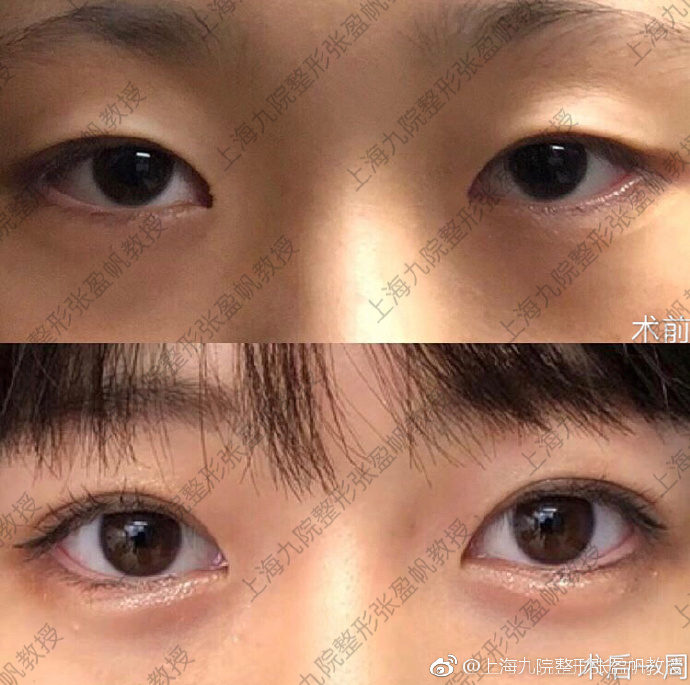 上海权威双眼皮专家和双眼皮修复都有哪些？